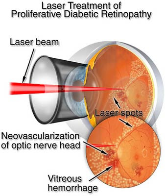 My OpToMeTRy JouRNey: June 2011