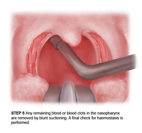 Tonsillectomy steps