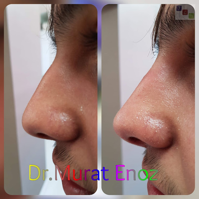 Non-surgical rhinoplasty in Istanbul - The 5 Minute Nose Job in Istanbul - Non-surgical nose job - Nose filler injection Turkey - Injectable nose job - Liquid rhinoplasty