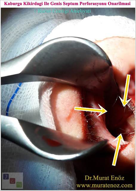 Nazal septum perforasyonu - Septum perforasyonu ameliyatı olanlar - Septum perforasyonu olanlar - Septum perforasyonu ameliyatı yapan doktorlar - Burunda delik oluşumu - Burun duvarında delik - Burun kıkırdak delinmesi tedavisi - Septum perforasyonu ameliyatı olanlar - Septum perforasyonu olanlar - Septal perforasyon tamiri - Septal buton uygulaması - Nazal septum perforasyonu tedavisi - Nazal septum perforasyonu nedenleri - Nazal septum perforasyonu belirtileri - Septum perforasyonun cerrahi onarımı - Burun delinmesinin nedenleri - Nazal septum perforasyonu tanısı - Erkek burun estetiği - Burun estetiği ameliyatı - Definition of Nasal Septal Perforation - Causes of Perforated Nasal Septum - Symptoms of Nasal Septal Perforation - Diagnosis of Nasal Septal Perforation - Surgical Treatment For Nasal Septal Perforation - Nasal Septal Perforation Repair - Surgical Repair of Nasal Septal Perforation