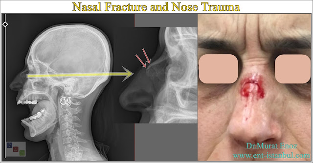 Nasal fracture symptoms,Nasal fracture,Nasal fracture reduction,Nasal fracture diagnosis,Broken nose,Nasal fracture treatment,Post-operative instructions for reduction nasal fracture,