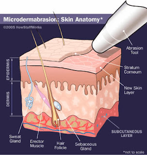 what is dermabrasion