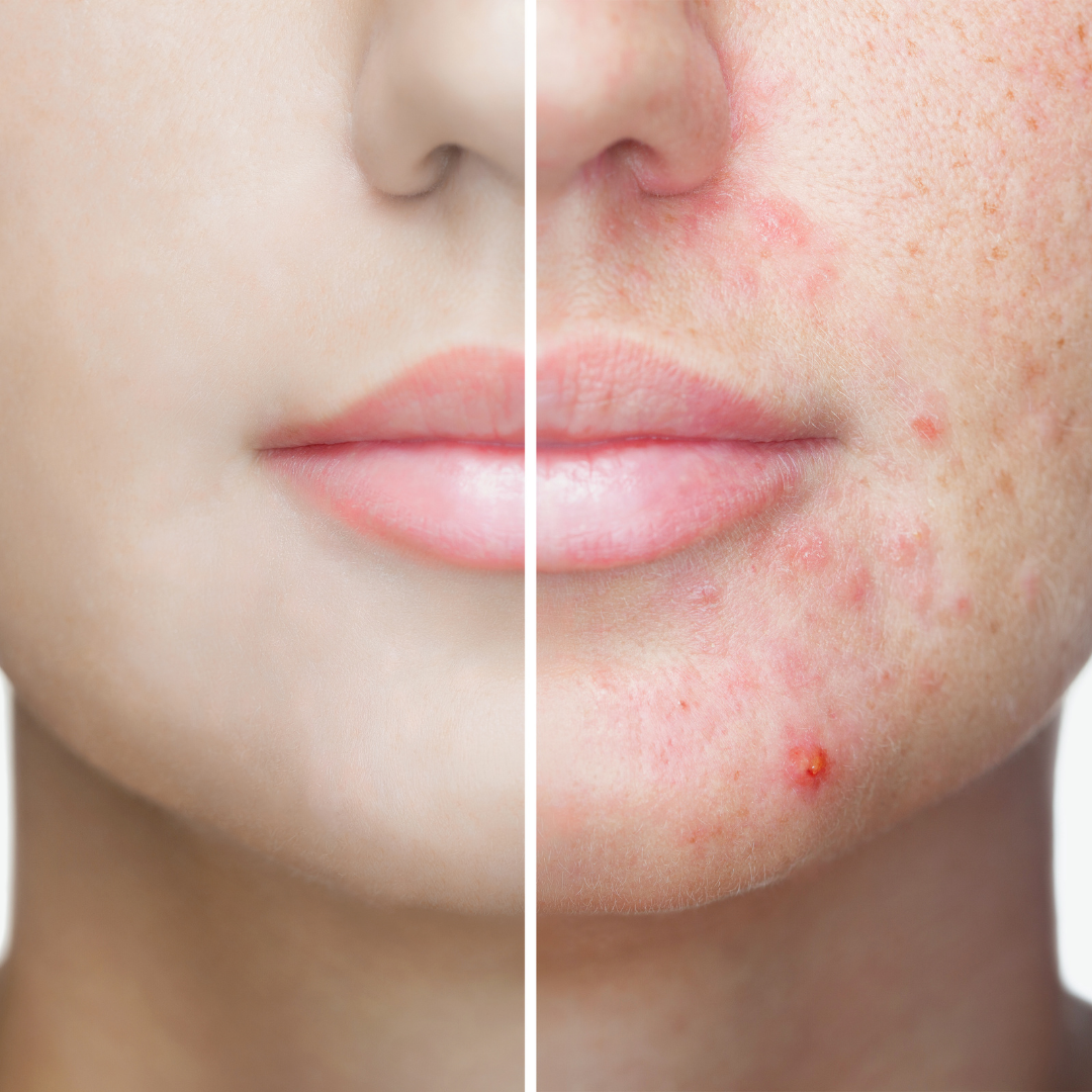 How to get rid of fungal acne or little bumps on your face