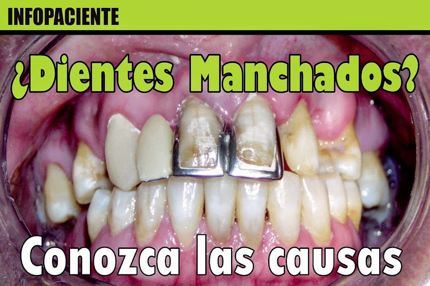 Dientes Manchados