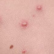chicken pox image