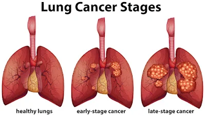 A recently publish The Diagnostic Accuracy of a Novel Scoring System Using Multi-Detector Computed Tomography to Diagnose Lung Cancer finds out that Lung cancer is prevalent in both men and women but affects men more often, particularly in the state of Mizoram in India.