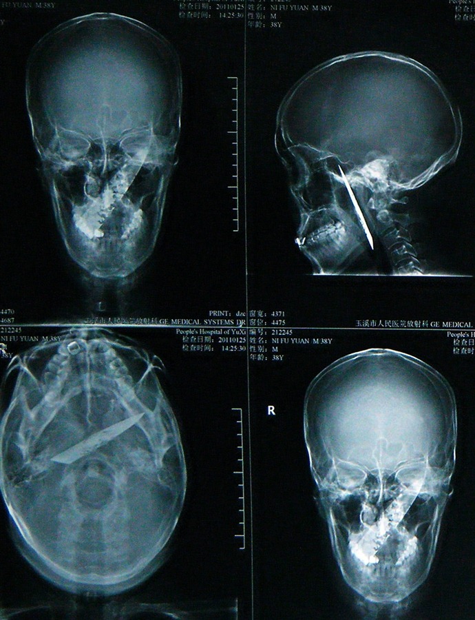 knife-in-head4