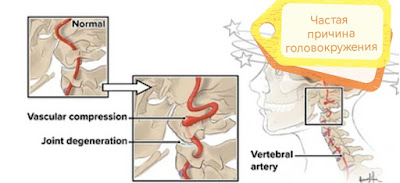 Головокружение от шеи
