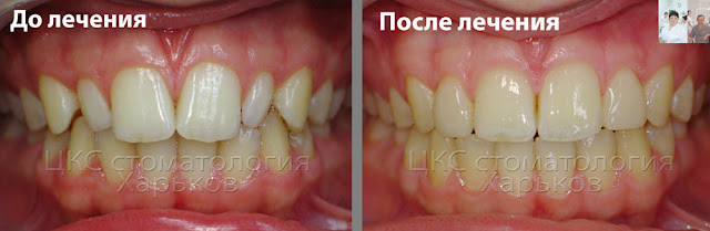 фотополимерные реставрации для рудиментарных зубов