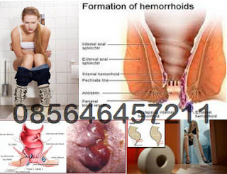 Lubang Pantat Sakit dan Kadang BAB Berdarah