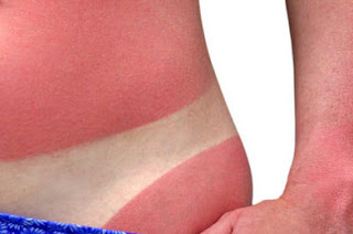 Vitamin D is a good remedy for sunburn.