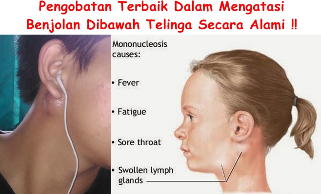 Obat Tradisional Benjolan Dibawah Telinga