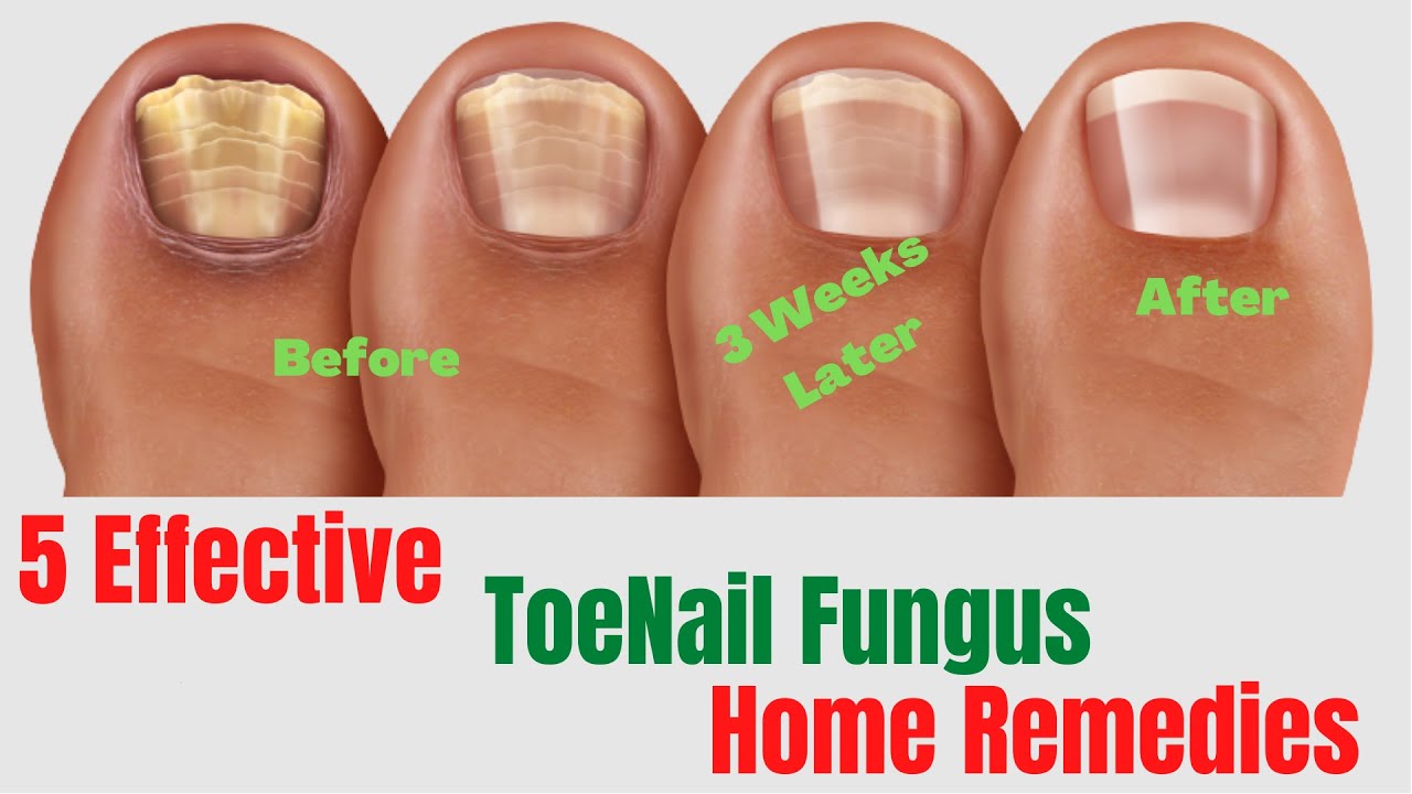 Foot Fungus Treatment