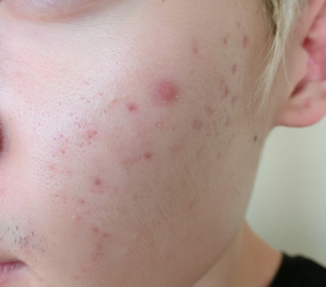 TylerHikaru: My Skincare Journey With Lush Aesthetics Pt 2