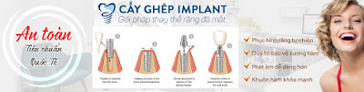 Cấy ghép Implant có rất nhiều ưu điểm