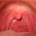 Triệu chứng, biểu hiện ung thư vòm họng