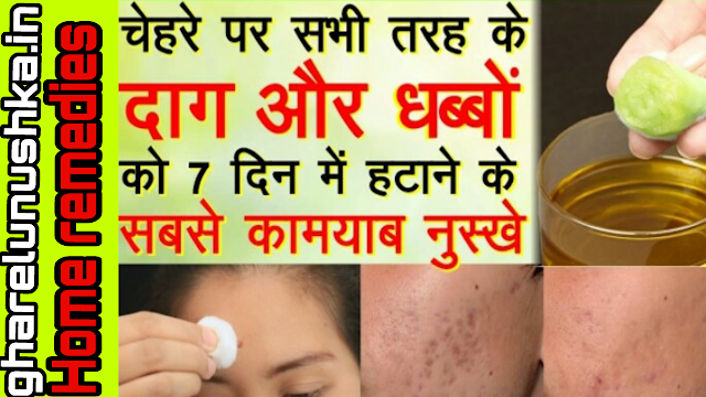 pimple ke daag kaise mitaye in hindi  | चेहरे के दाग धब्बे मिटाने के घरेलू उपाय