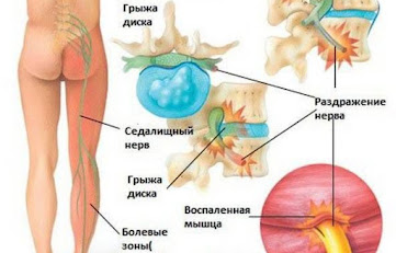 Ишиас это  боль от поясницы.