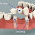 Giải pháp tân tiến nhất cho người mất răng