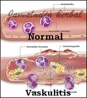 https://avinnetaherbal23.blogspot.com/2018/10/obat-herbal-untuk-mengobati-vaskulitis.html