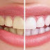 Có tẩy lúc nào cũng nên tẩy trắng răng không?