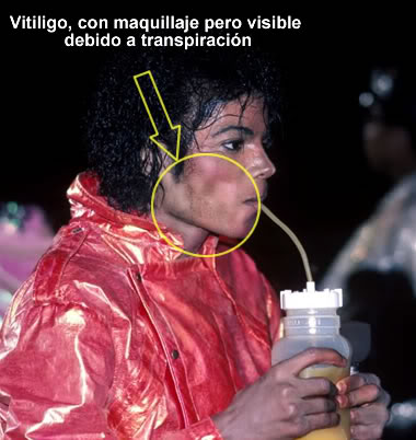 Michael Jackson Vitiligo