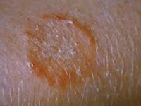 Health authorities concerned over spread of ’’TINEA’’.