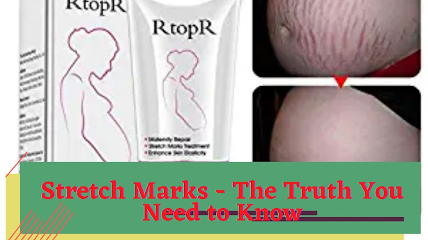 pregnancy stretch marks