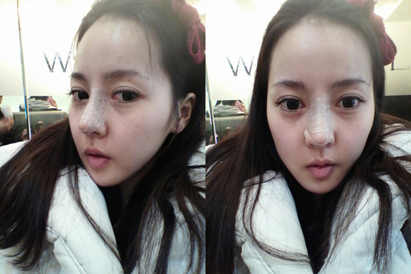 짱이뻐! - Wonjin Nose Surgery To Get Nose Like a Doll