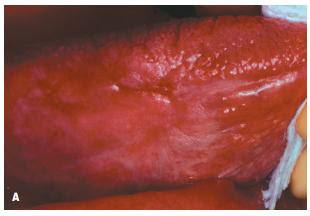 LICHENOID REACTIONS