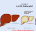 Liver damage symptoms in hindi | अगर हैं ये लक्षण, तो समझ जाएं पूरी तरह से डैमेज हो गया है लिवर