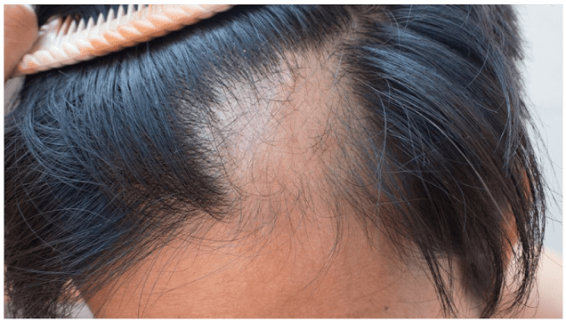 Alopecia Areata