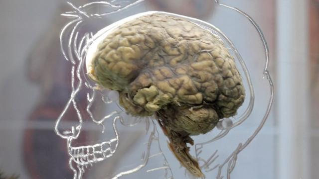 Being Brain Dead