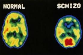 schizophrenia behavior 