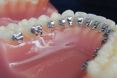 Quy trình niềng răng mặt trong tại nha khoa