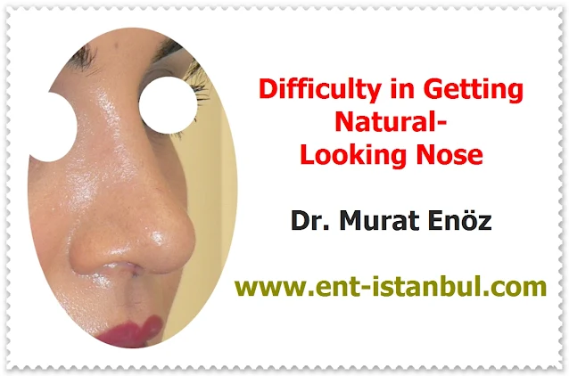 Natural looking rhinoplasty - Natural nose job - Natural rhinoplasty - Natural structure rhinoplasty - Natural nose rhinoplasty - Rhinoplasty in istanbul - Rhinoplasty in Turkey - Nose job in istanbul - Rhinoplasty istanbul - Rhinoplasty Turkey -  Nasal aesthetic surgery in İstanbul - Nose aesthetic surgery in Turkey - Nose job İstanbul - Nose job Turkey - Nose reshaping in İstanbul - Nose correction surgery in İstanbul