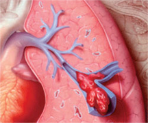 Pulmonary Embolism Symptoms, Causes and Treatment