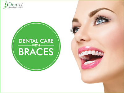 Dental Braces at Dentzz