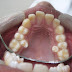 Growing multiple new teeth from single tooth germ