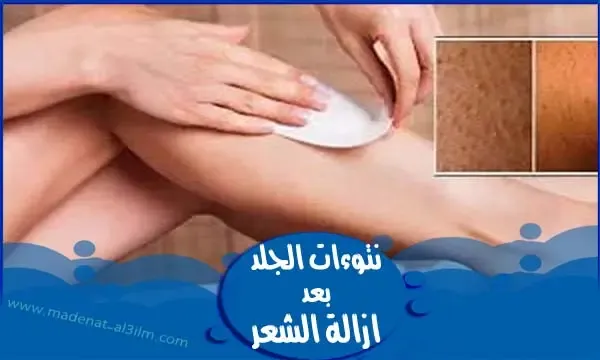 إزالة الشعر