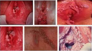 Obat Sipilis Gatal Di Penis