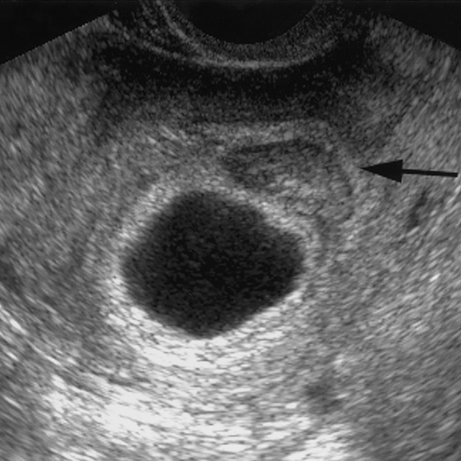 Dr. Ferry Fawzi Annor: Toxoplasmosis Penyebab Blighted Ovum