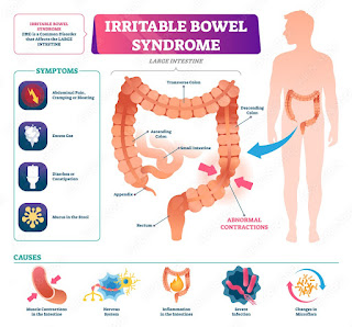 Symptoms of Irritable Bowel Syndrome