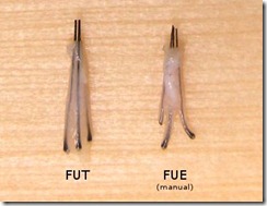 difference between FUE and FUT