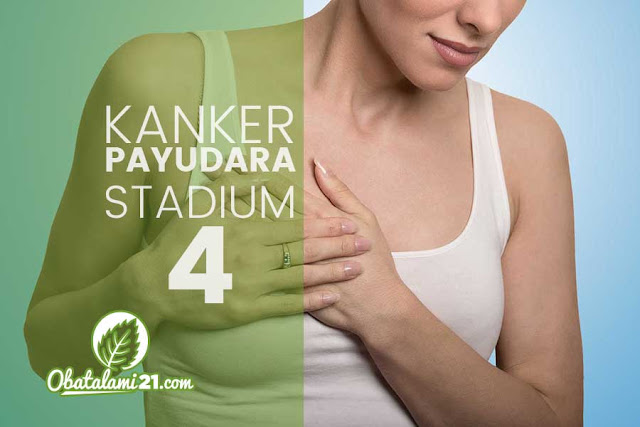 Apakah Kanker Payudara Stadium 4 Bisa Sembuh