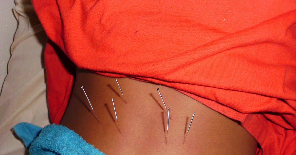 Acupuncture & Alternative Treatment: What Do You 