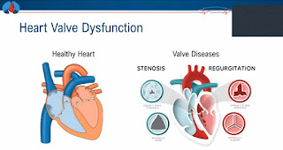 Heart diseases, symptoms and treatments
