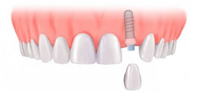 Quy trình thực hiện hàm phủ trên Implant