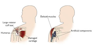 Shoulder replacement - Aakashealthcare