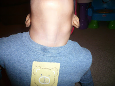 his swollen lymph nodes.